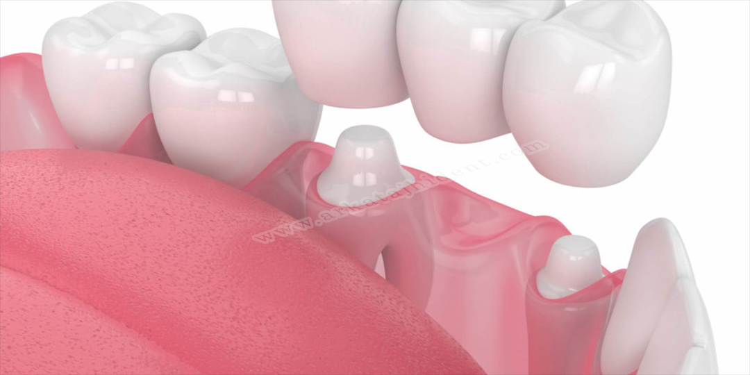 پروتز دندان را بهترب شناسیم