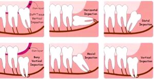  impacted-wisdom-tooth