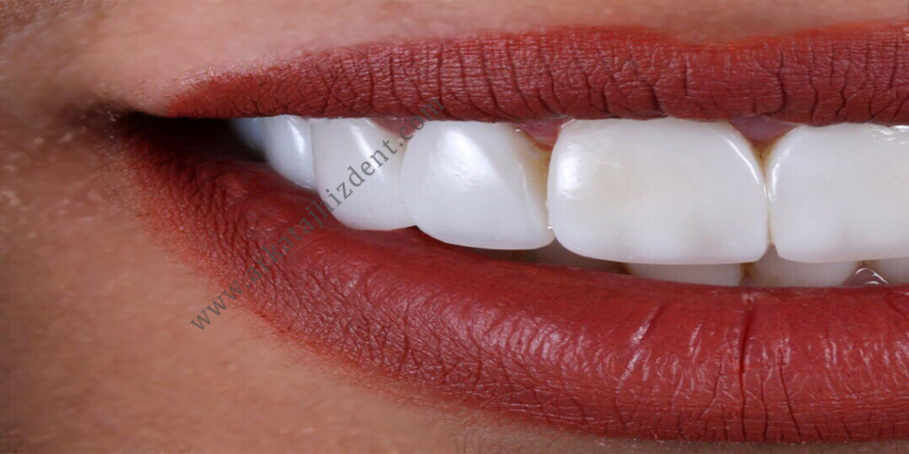 آیا درمان های سفید کننده دندان در مطب موثر هستند؟