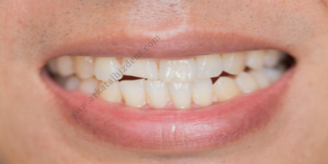 درمان شکستگی یا ترک دندان
