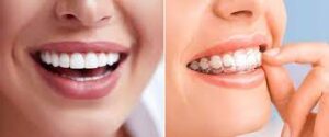 وینر یا الانیر شفاف تجهیزات دندانپزشکی